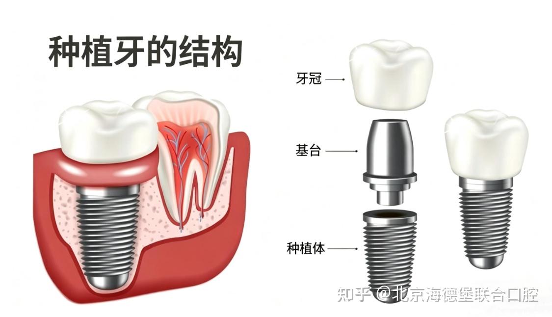 北京种植牙价格|海德堡联合口腔以德系标准惠民 - 知乎
