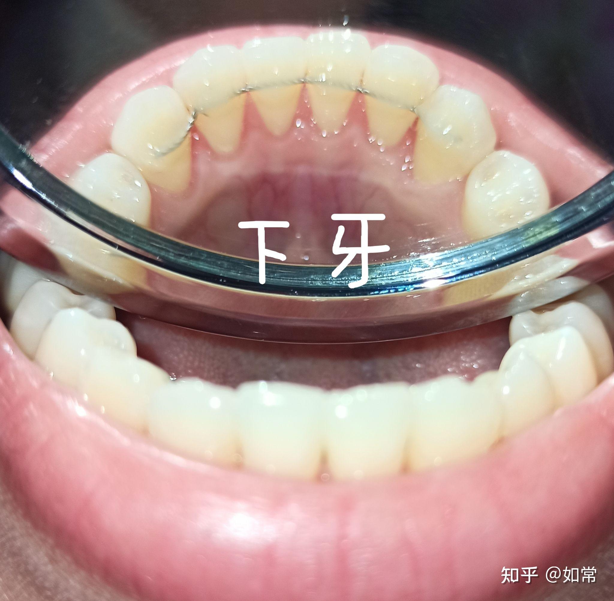 门牙戴牙冠的过程图解-图库-五毛网