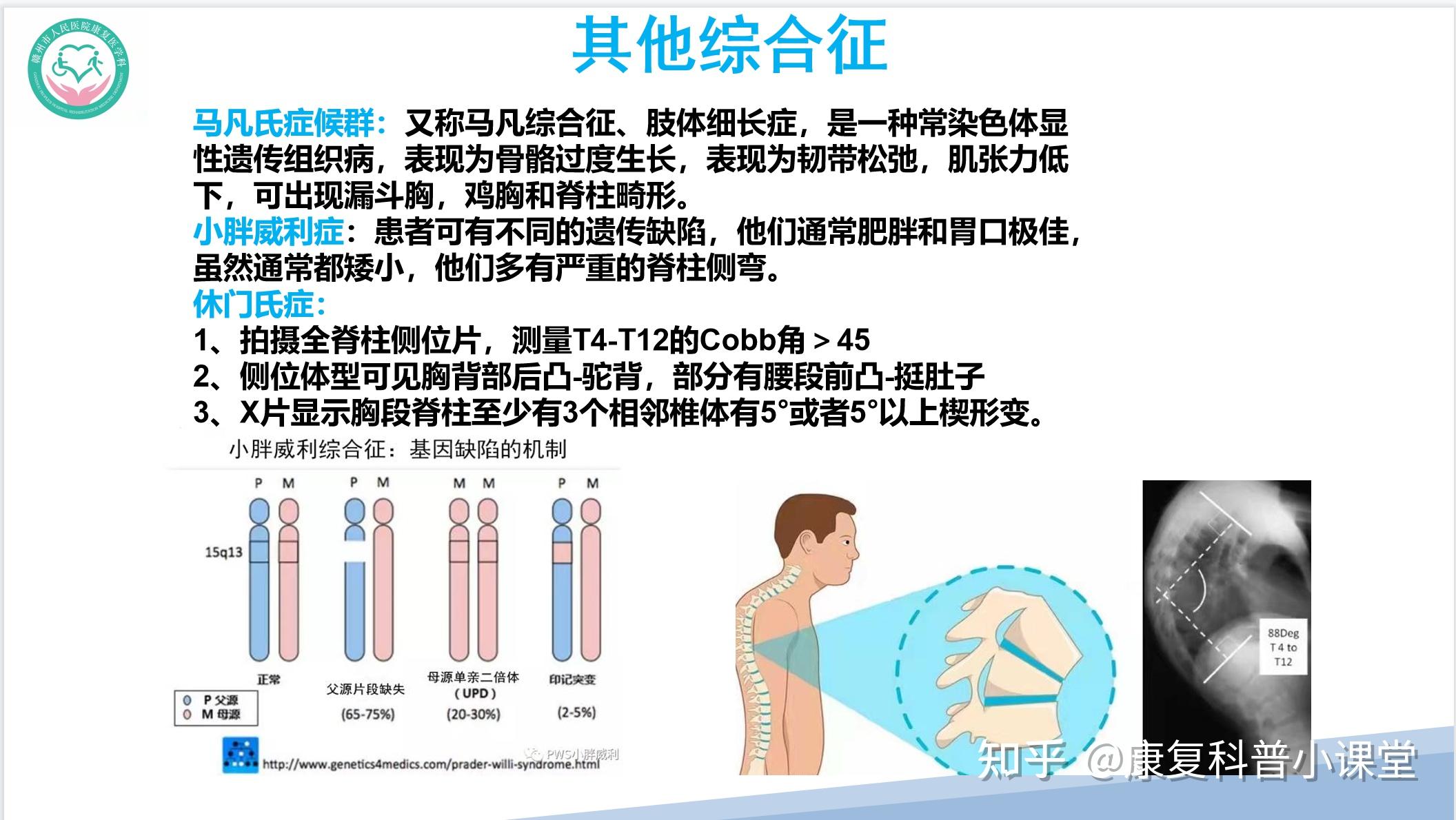 特发性脊柱侧弯的诊疗策略 - 知乎