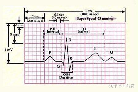 正常心电图是什么样的 我的心电图正常吗 知乎