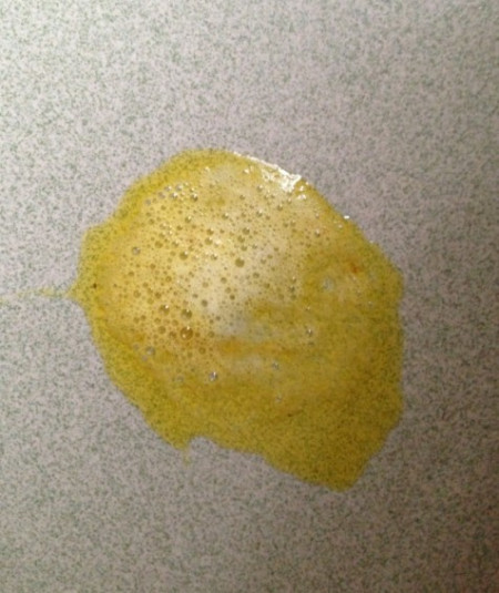 若呕吐物中呈现黄绿色,也就是常说的吐黄水,常提示十二指肠阻塞,胆汁