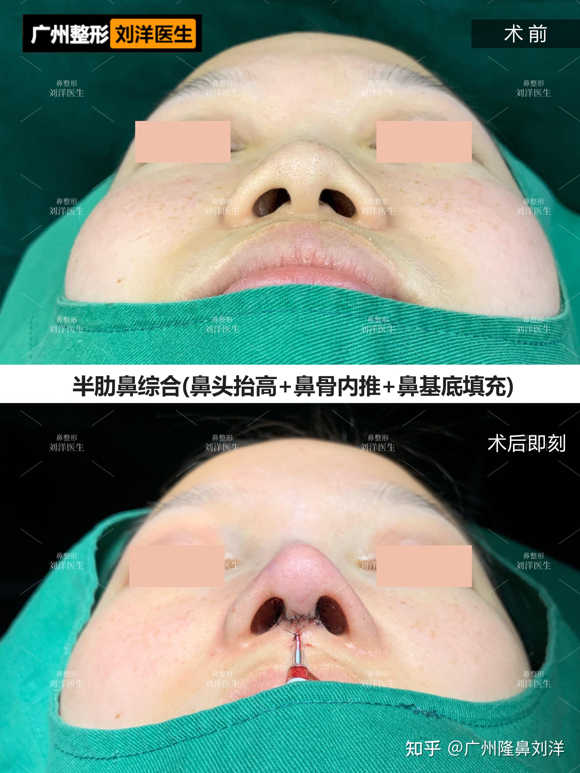 3次肋骨鼻修复，打造圆润小翘鼻既往手术史：1、硅胶_圈子-新氧美容整形