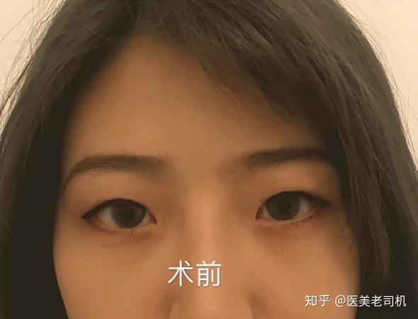 怎样才能有双眼皮 v2-a3f0f89fd8238106f9ebe47aac7d750f_r.jpg