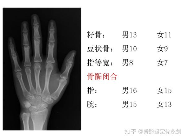 详解骨龄检测G-P骨龄图谱（男生版） - 知乎