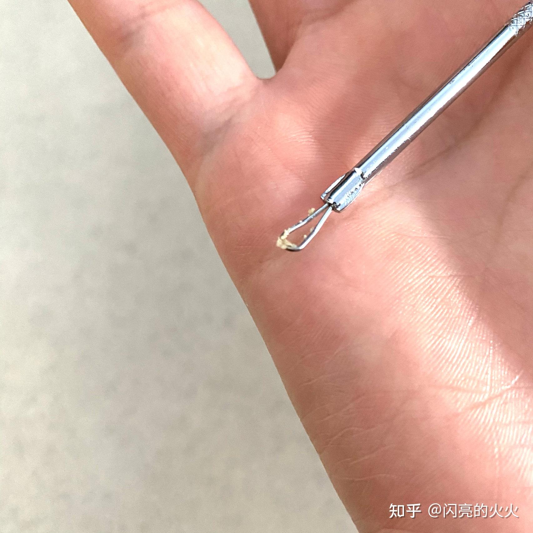 第三步:掏出粉刺针!