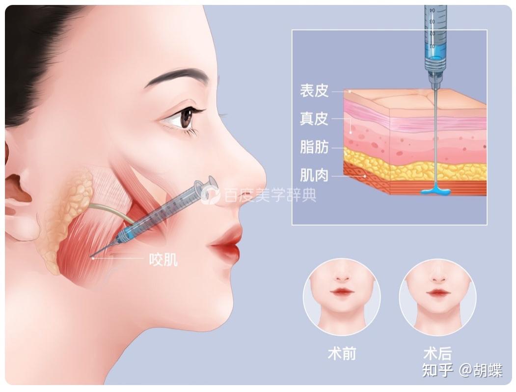 瘦脸针瘦了吗