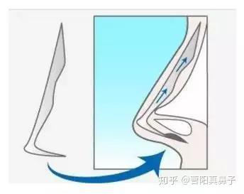 隆鼻后鼻尖发红是什么原因造成的