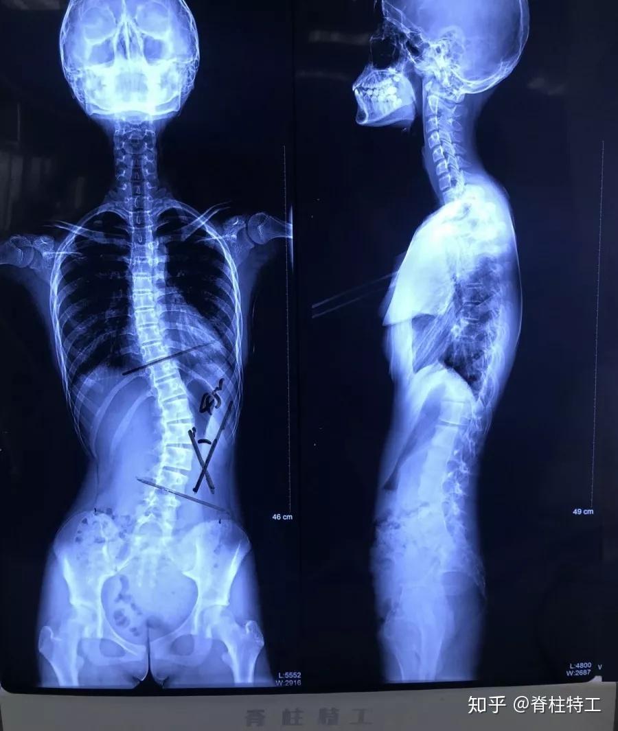 实录我陪女儿治疗脊柱侧弯的这三年