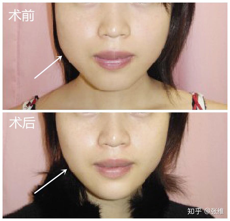 脸大矫正之去颊脂垫篇! - 知乎