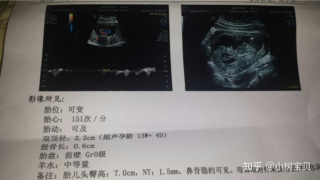 3,孕11~13週期間:nt彩超檢查(胎兒第一次畸形篩查檢查)