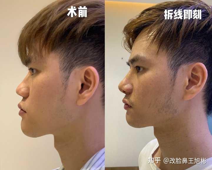 隆鼻效果有多惊艳?