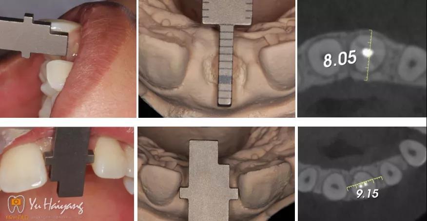 上頜中切牙外傷冠折後數字化即拔即種即修復92例 - 知乎
