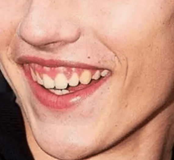 露龈笑怎么解决