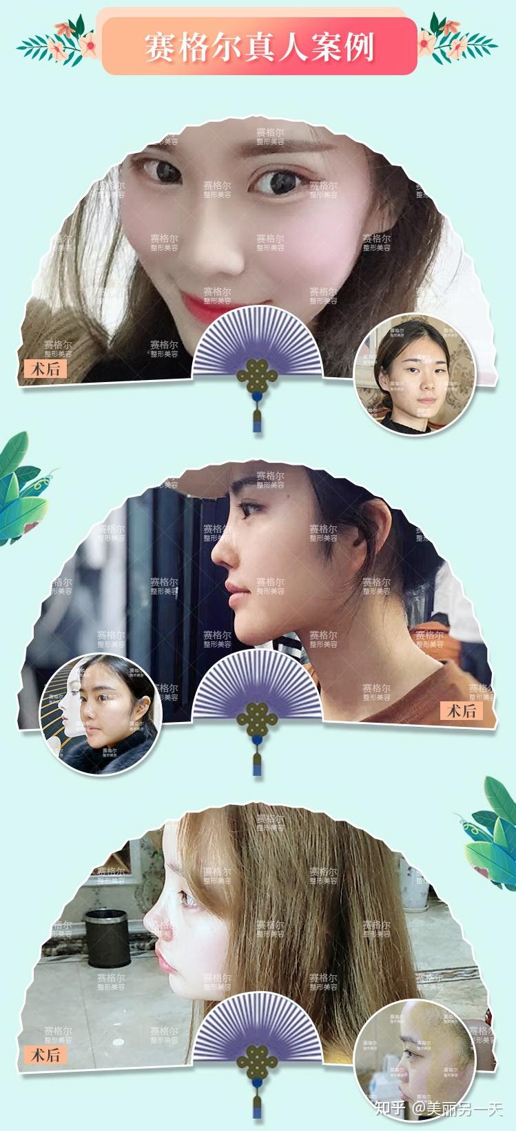 马鼻子说隆鼻:鼻综合整形手术中的美学