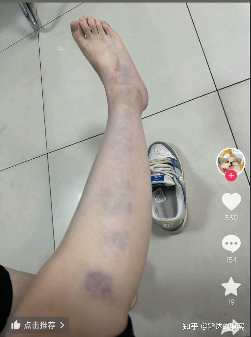 知名解说员孔祥宇的妻子"酥饼"近日公开提出离婚,并晒出腿部淤青照片