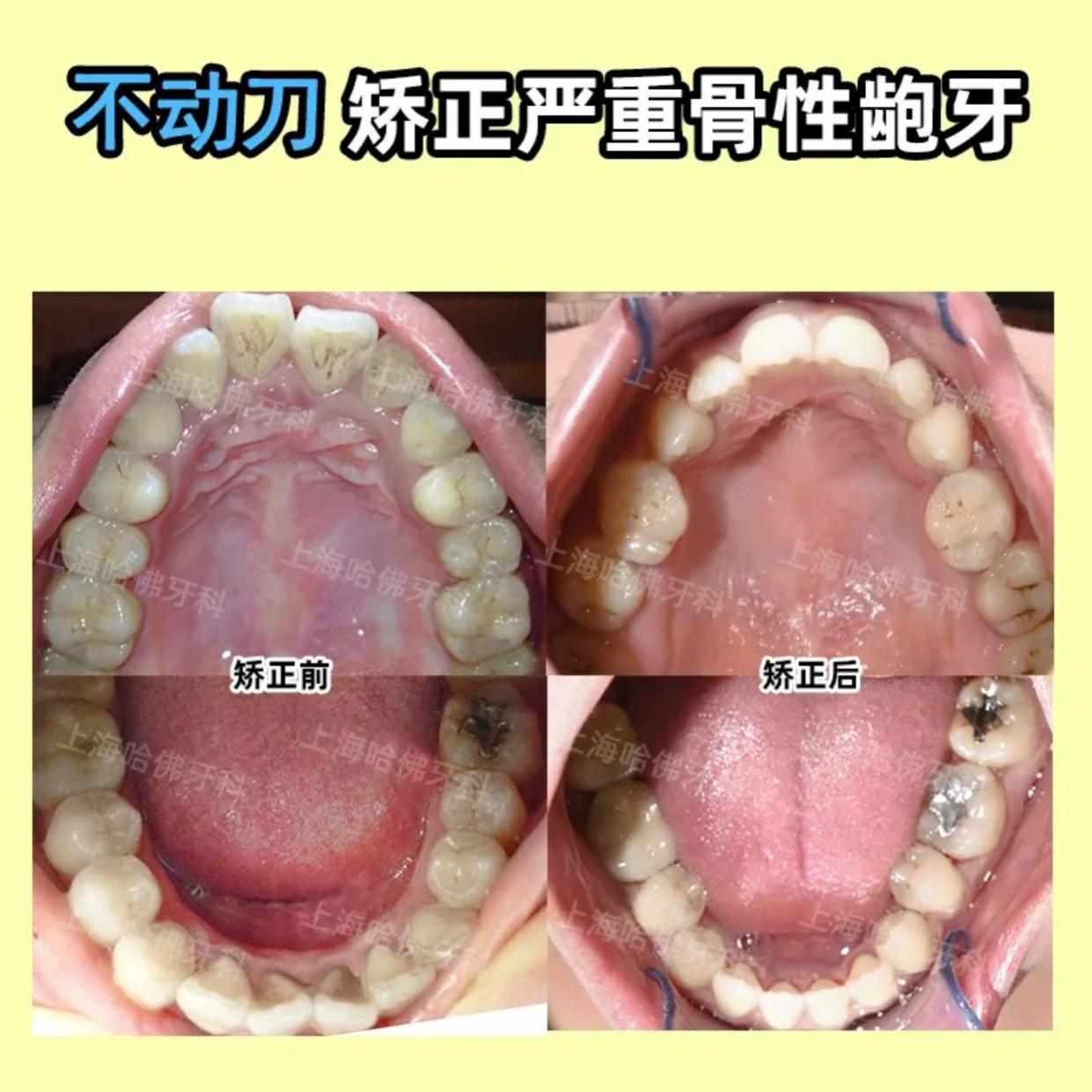严重骨性龅牙只能做正颌手术这可不一定