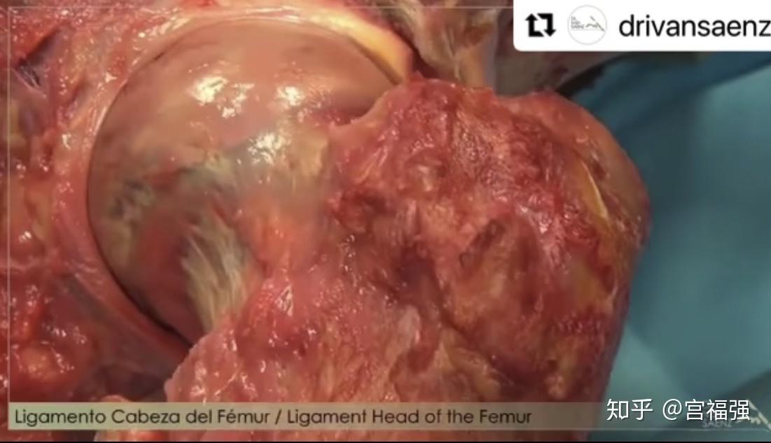 股骨头(caput femoris)呈圆形,约占一圆球的2/3,其上完全为关节软骨所