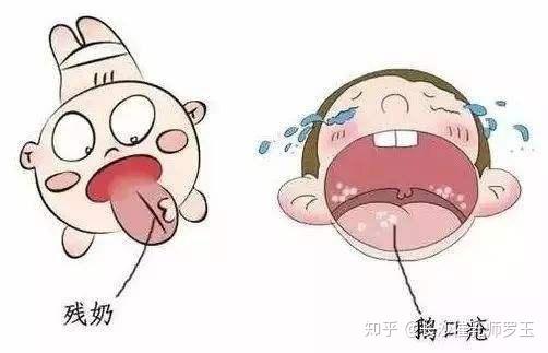 怎样分辨鹅口疮和奶垢得了鹅口疮该怎么办