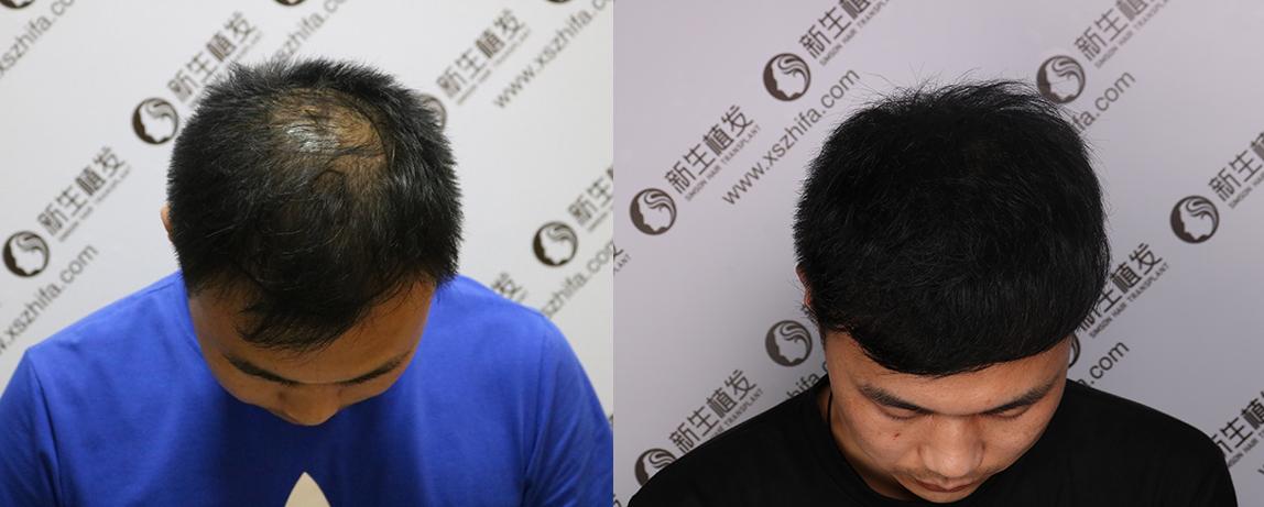 植发靠谱吗？用这20个植发的例子告诉你答案！ - 知乎