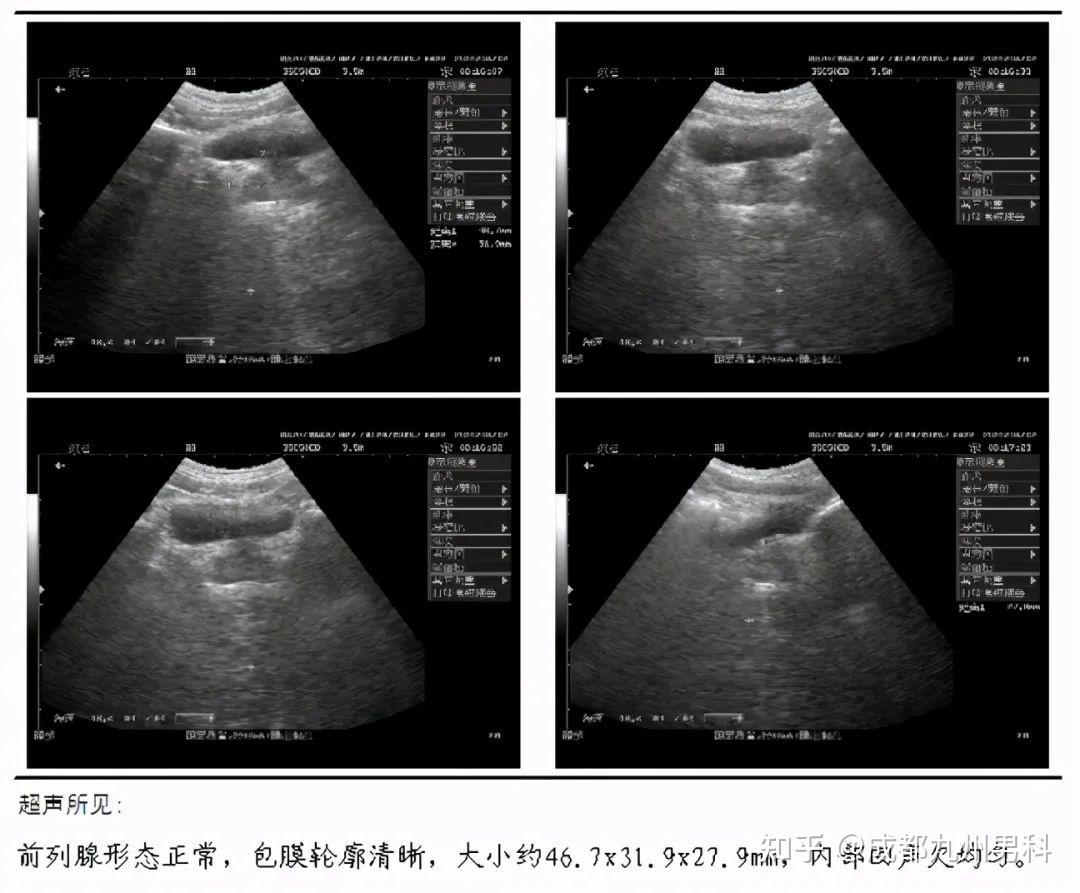 男性前列腺增生必须医治吗