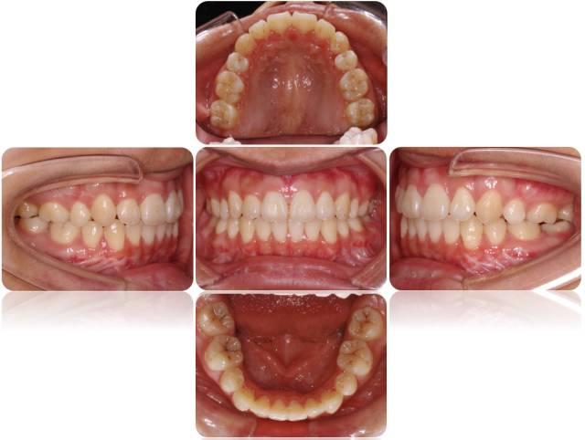 正畸-正颌联合治疗:是指对生长发育完成后的严重骨性牙颌畸形配合外科