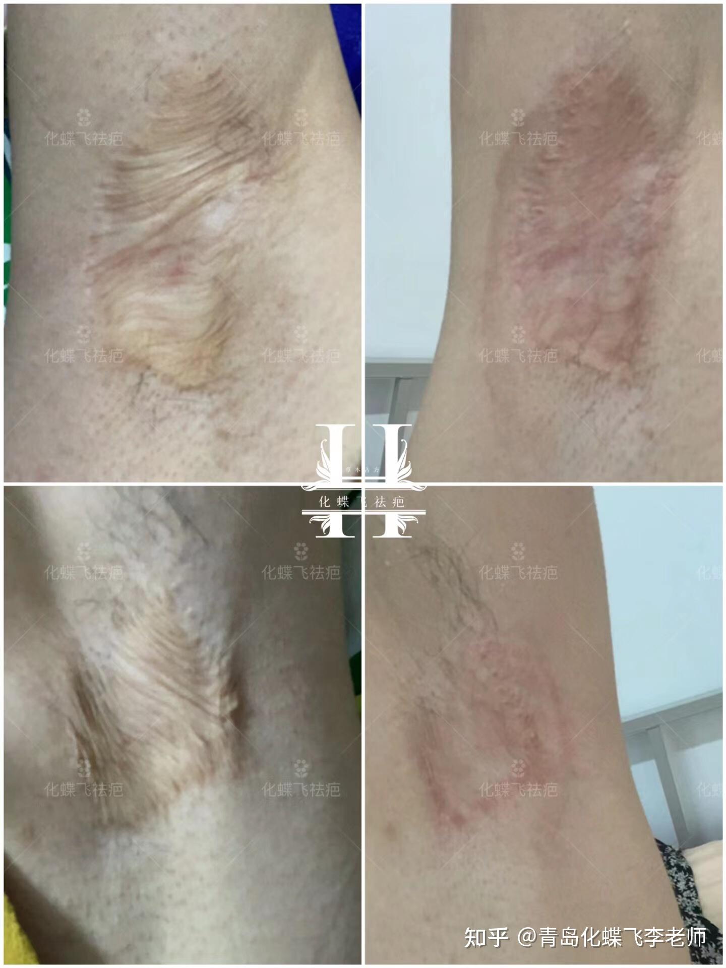 五年多的腋下手术疤痕