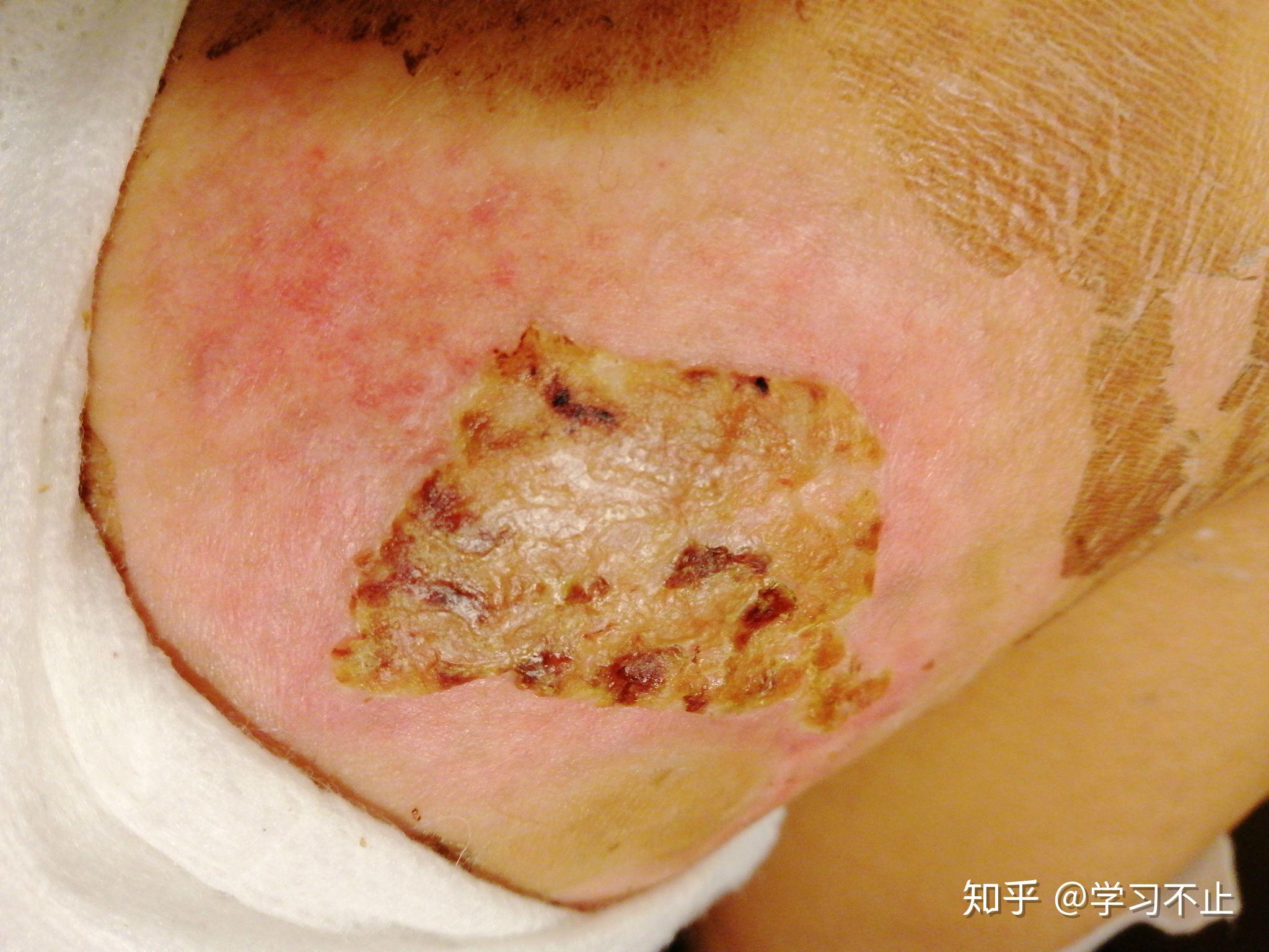 巴黎烫伤脱皮记