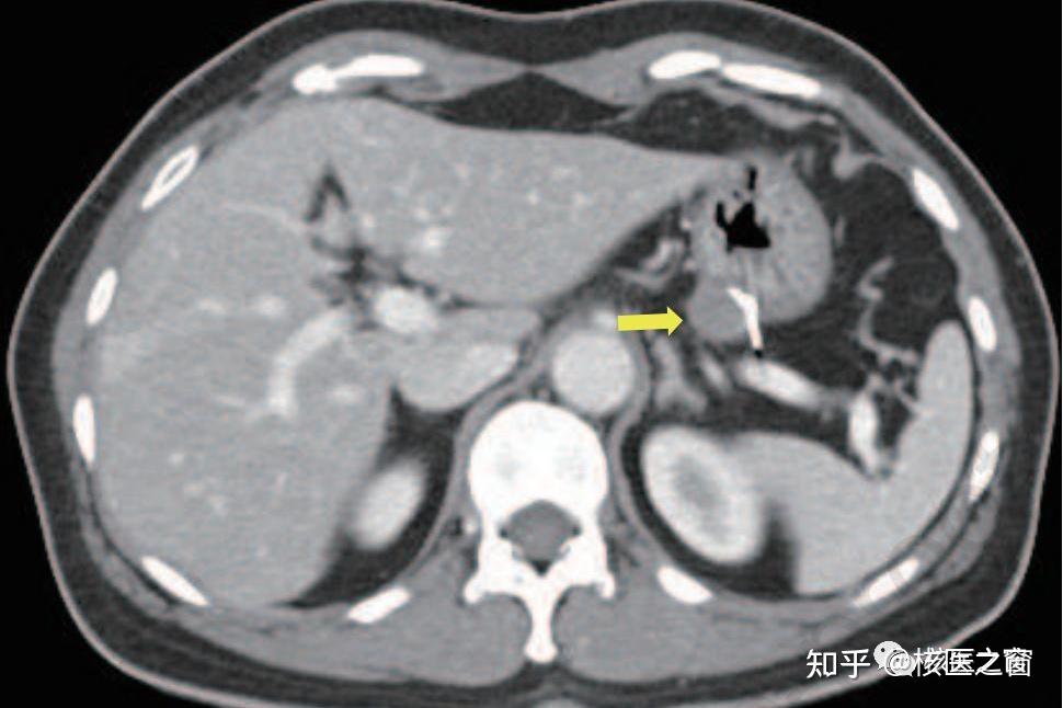 PET/CT检查：解秘“喝水”的那些事 - 知乎