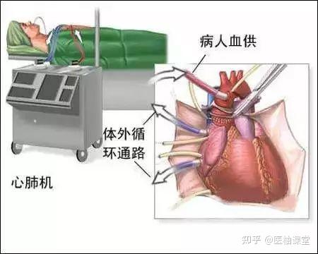 图解 心脏搭桥是怎么搭的