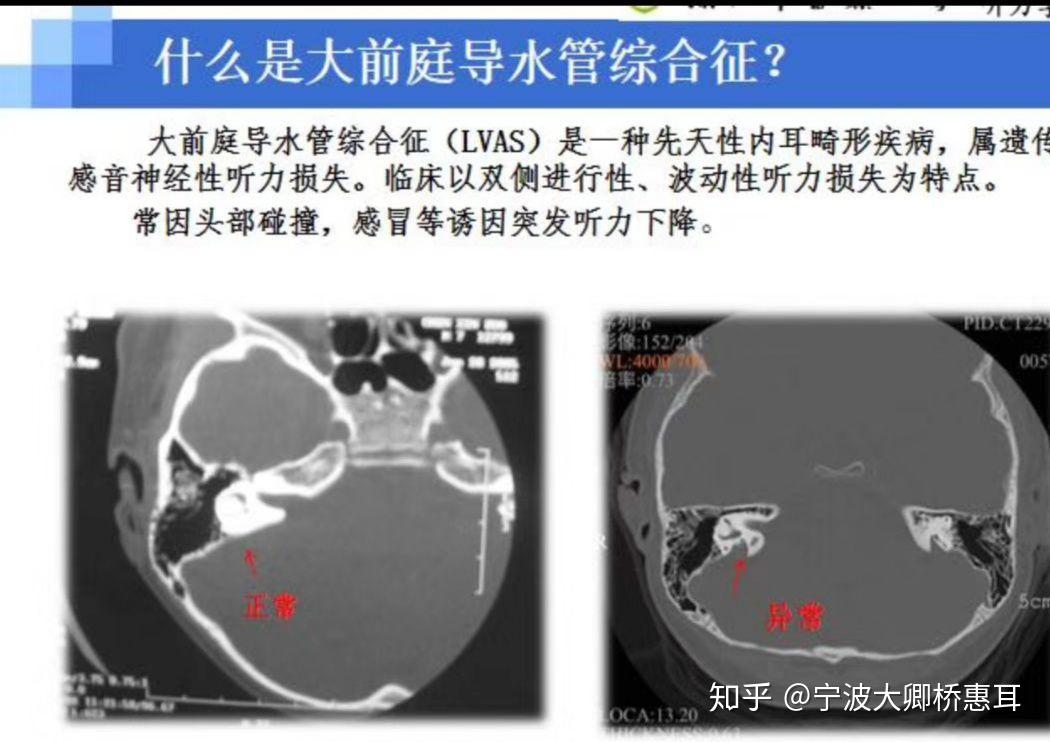 大前庭导水管综合征的治愈方案,收藏一下!