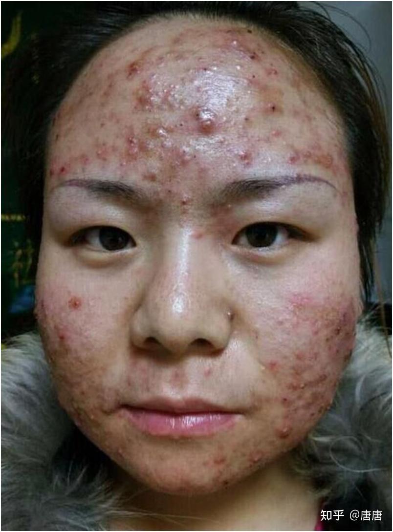 脸上长痘痘怎么办