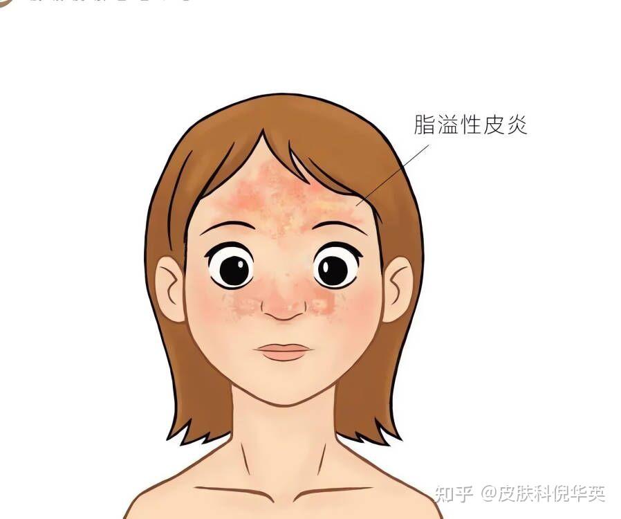 “面部皮炎”知多少 - 知乎