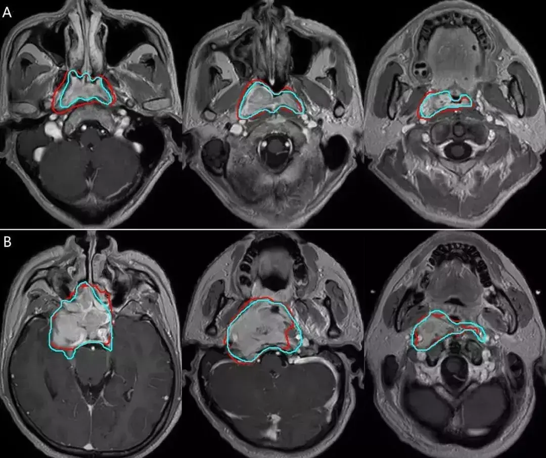 中山肿瘤联合视见科技和港中大实现鼻咽癌放疗靶区人工智能自动勾画