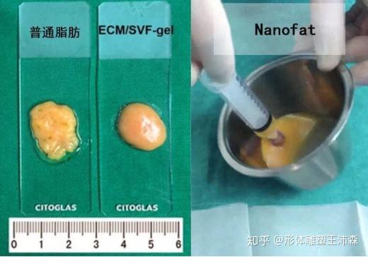 解析：脂芯SVF-gel脂肪胶是什么？它长什么样子？ - 知乎