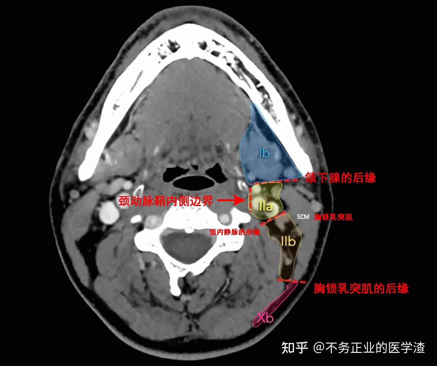 内乳淋巴结ct片图解图片