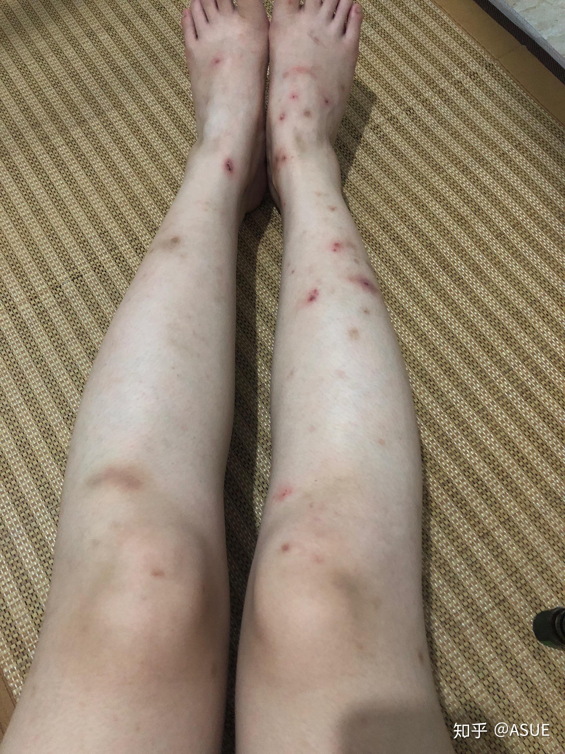 被蚊子咬了留疤怎么办