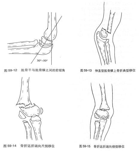 上肢骨折与脱位 笔记 知乎