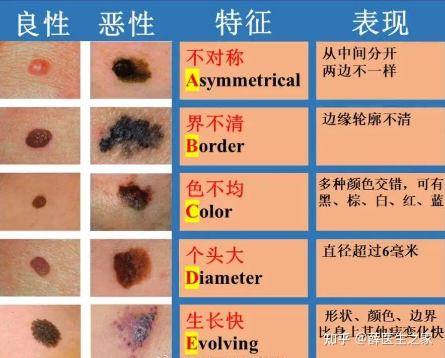 各种皮肤癌图片 区别图片