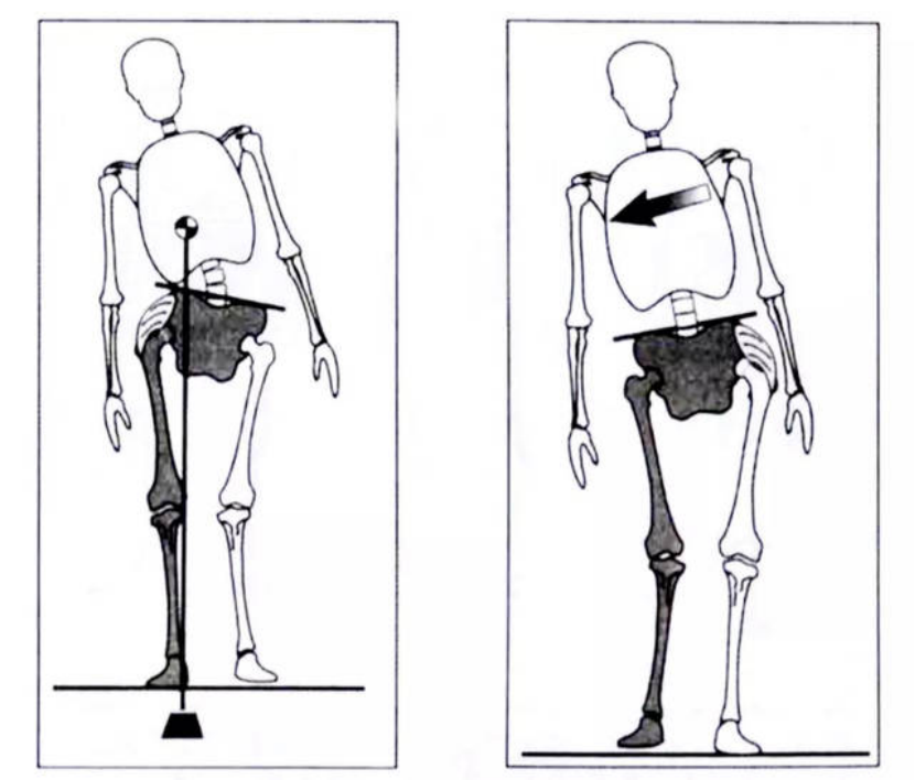 臀中肌无力（鸭子步态） - 知乎