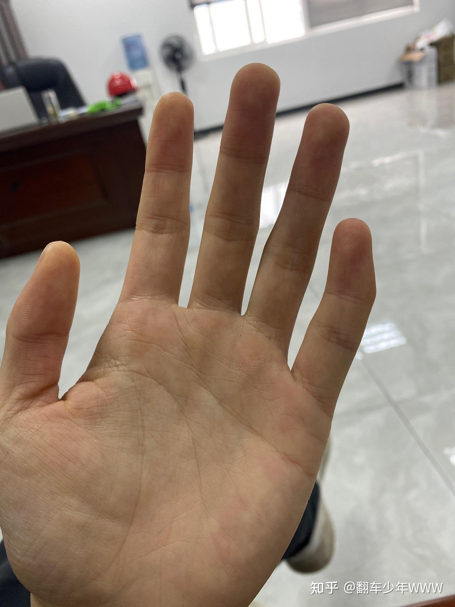 左小指第一指节弯曲怎么怎么矫正? - 知乎