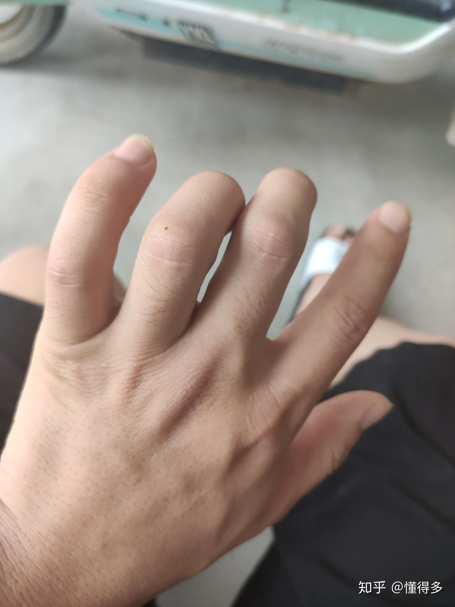 本人女左手无名指半年前多新长了一颗痣 有什么寓意? - 知乎