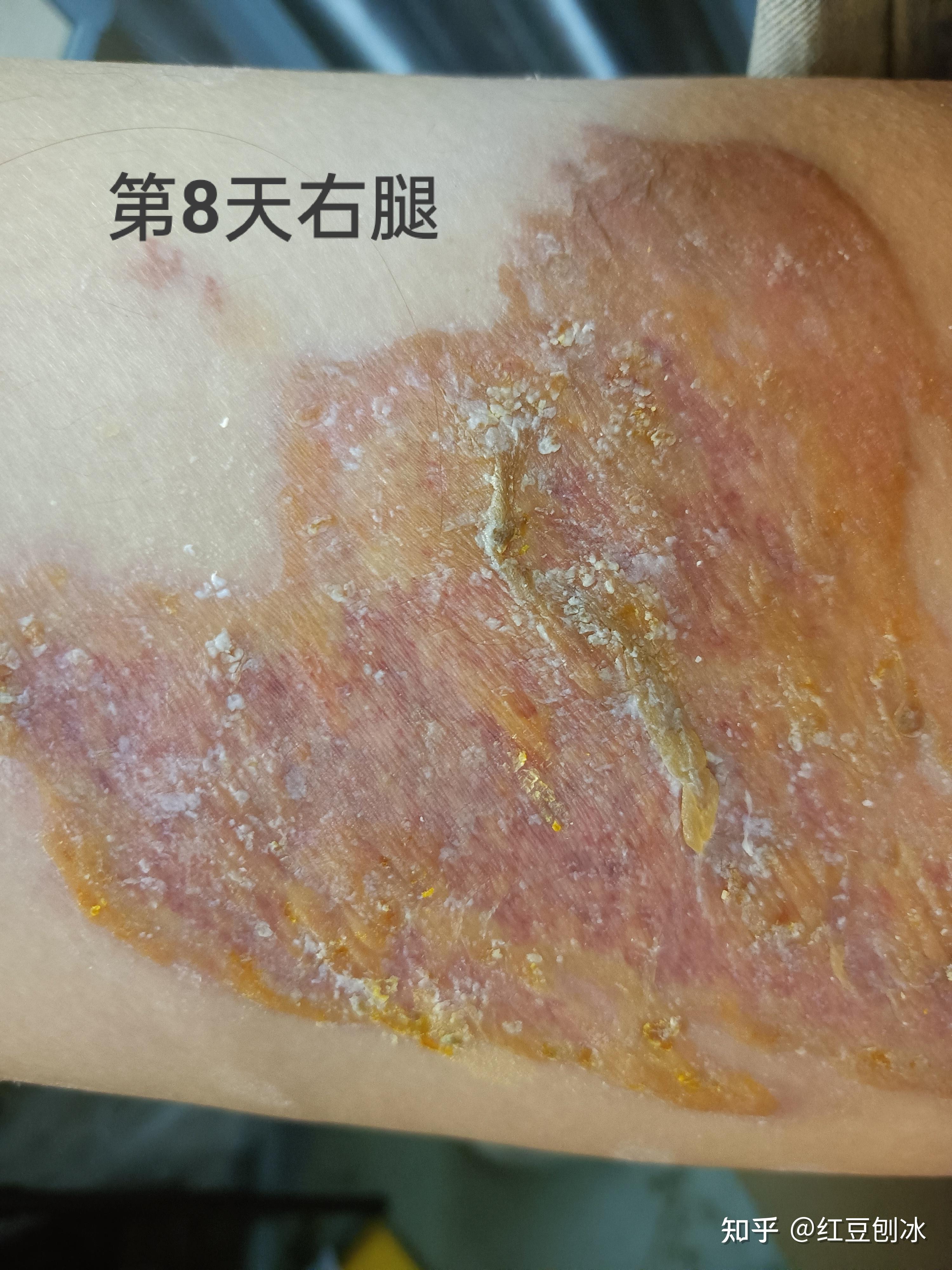 3月12日这个时候才能真正知道到底哪些地方是浅二度烫伤,哪些地方是深