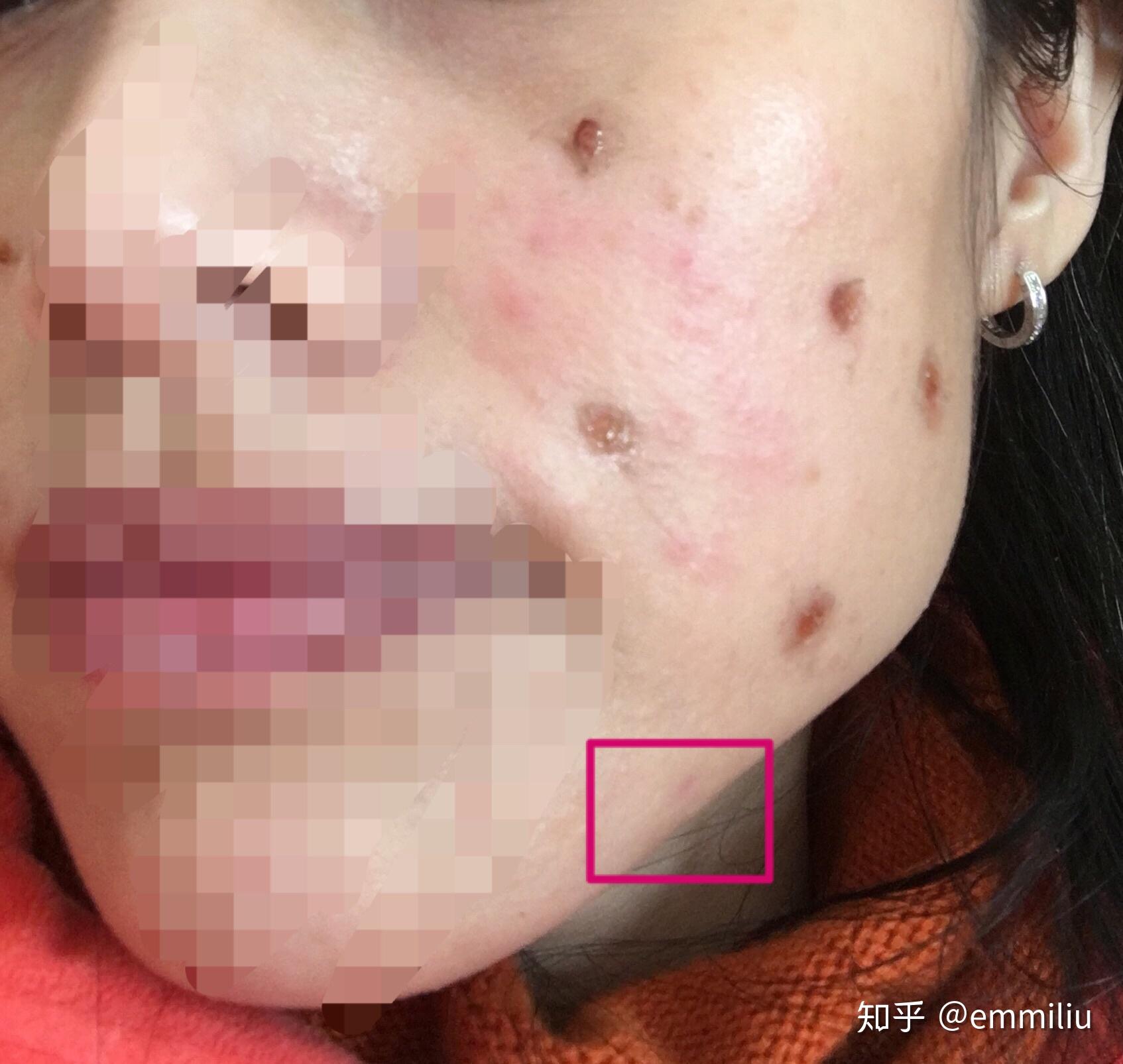 记录我的点痣过程
