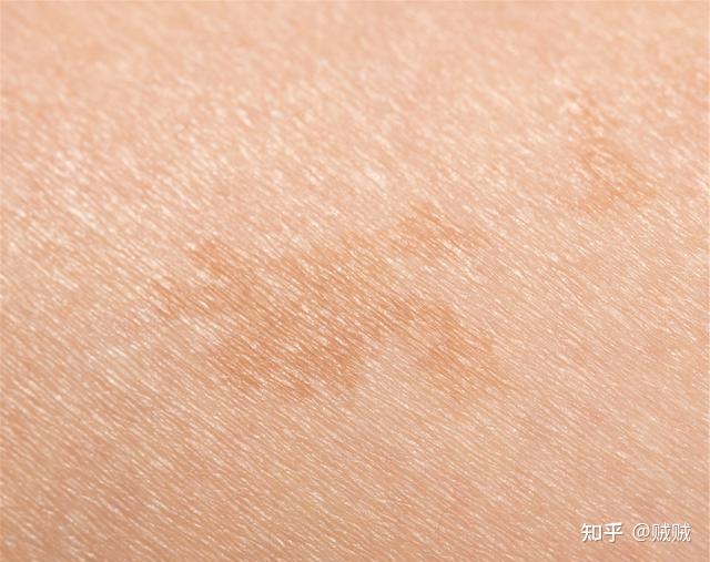 背上光滑鸡皮疙瘩(背部出现鸡皮疙瘩状皮肤) 背上光滑鸡皮疙瘩(背部出现鸡皮疙瘩状皮肤)