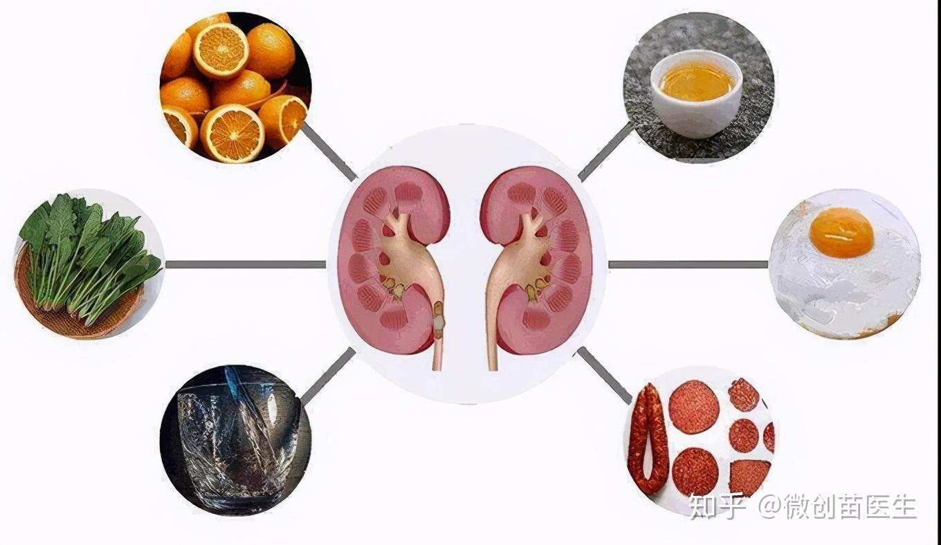 辟谣补钙会引起肾结石吗