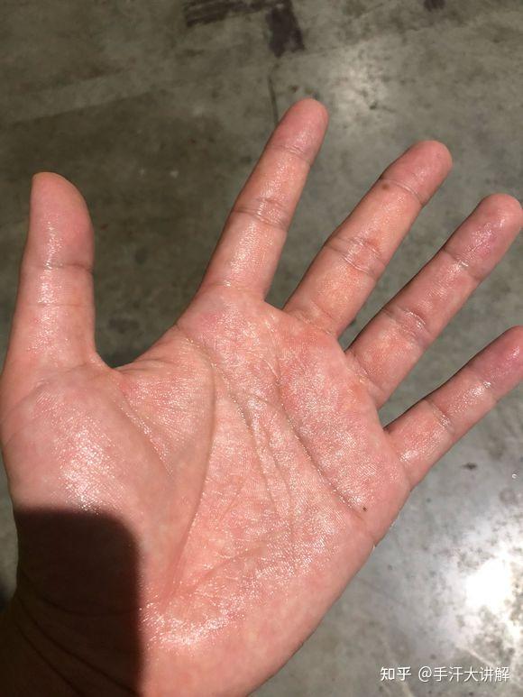 手汗症能自愈吗