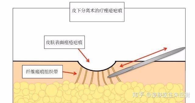 皮下分離術常見問題解答