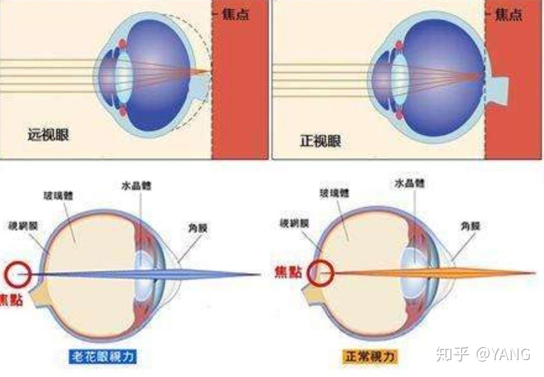 得了近视之后还会老花眼吗