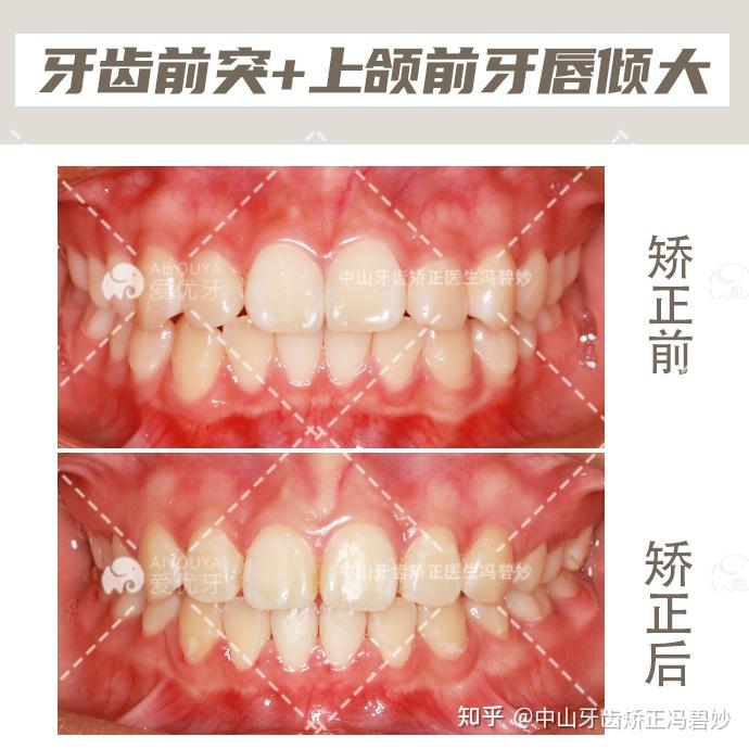 中山牙齿矫正前牙唇倾度大正畸实现侧貌协调美观