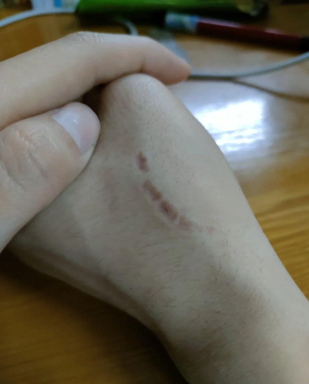 狗咬的牙印前任女友每次大姨妈的时候我都开心的像是过年到现任女友这